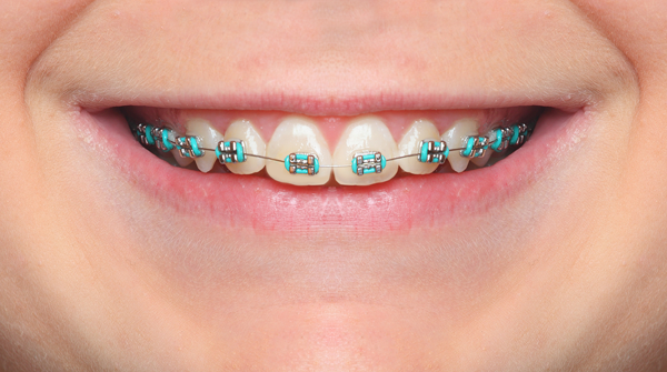 Braces (Traditional Braces) in Atlanta & Marietta, GA