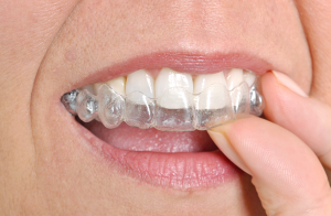 Invisalign® (Clear Braces) in Atlanta & Marietta, GA