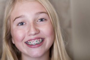 Adult Treatment for Aligning Teeth (Orthodontics)