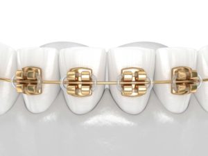 Gold Braces in Atlanta & Marietta, GA